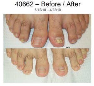 before after lunula 1